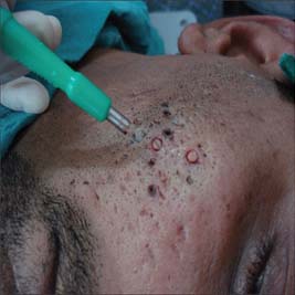 acne-scar-surgury