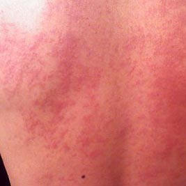 atopic-dermatitis/improving-the-itch