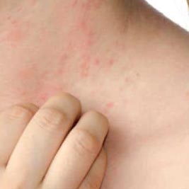 atopic-dermatitis/treating-the-rash