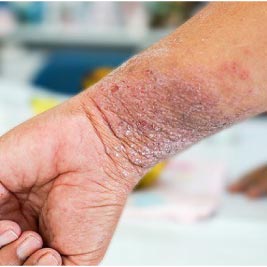 causes of atopic dermatitis