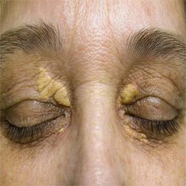 blepharoplasty what eyelid surgery can treat