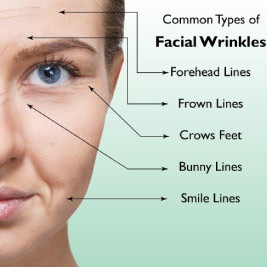 What are the lines and wrinkles treated by botulinum toxin?