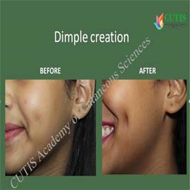 dimple creation procedure and post procedure