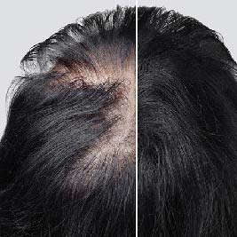 Transient hair loss