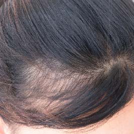 What causes androgenetic alopecia