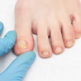 Ingrown toenail treatment