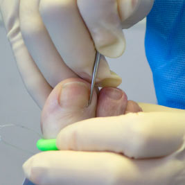 nail-surgury-procedure