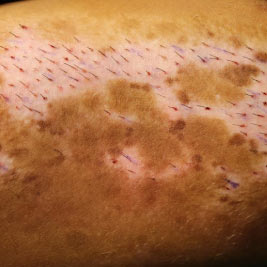 vitiligo-surgery-fue-ht