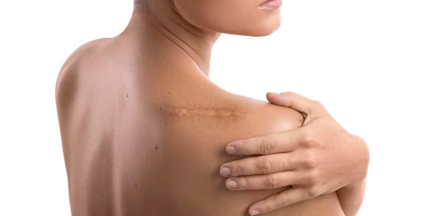 HOW TO GET RID OF OLD SCARS?