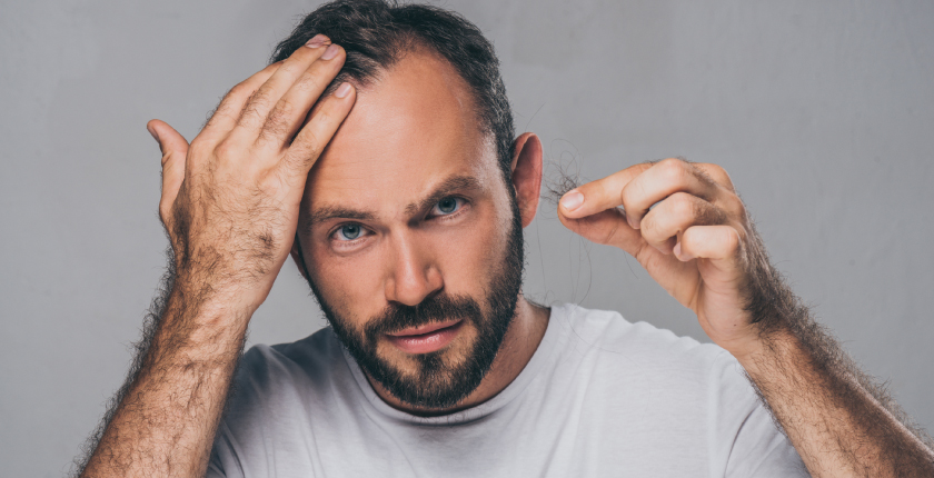 DECODING MALE PATTERN BALDNESS: CAUSES, STAGES, AND SOLUTIONS