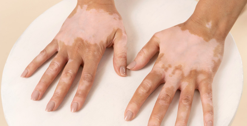 UNDERSTANDING VITILIGO: SYMPTOMS, TREATMENT, AND HOPE FOR A CURE