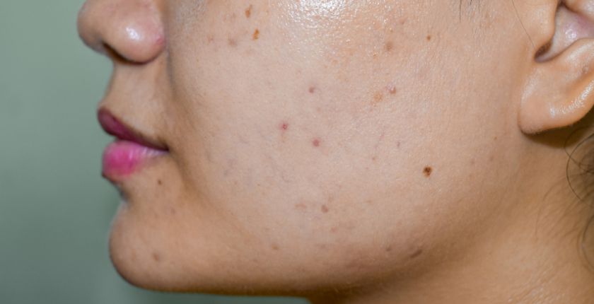 UNDERSTANDING ACNE VULGARIS: PREVENTION AND TREATMENT OPTIONS