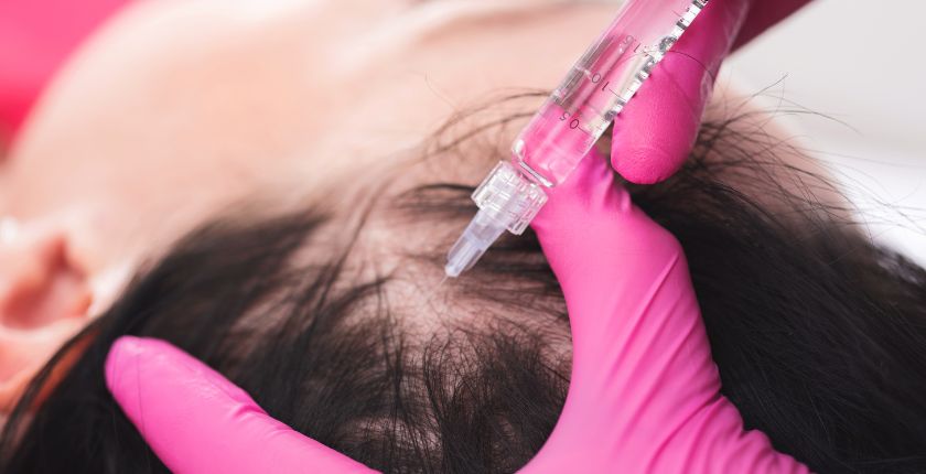 PLATELET-RICH PLASMA (PRP) FOR HAIR LOSS: HOW EFFECTIVE IS PRP FOR HAIR REGROWTH?