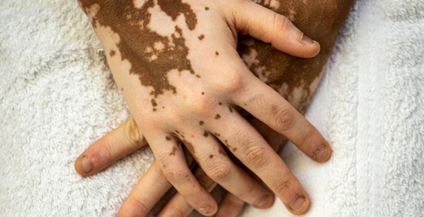 VITILIGO - SYMPTOM, TREATMENT AND CAUSES