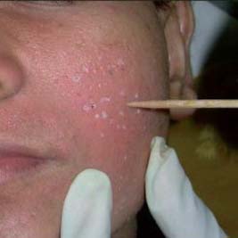 acne scar surgery chemical reconstruction of skin scars
