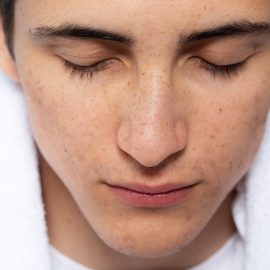 acne-scar-surgeries/soft-fillers