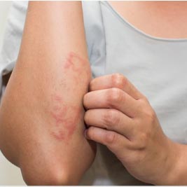 Atopic dermatitis differ in adult and childers