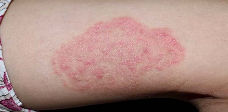 What is ringworm-fungal infection?,生癬-真菌感染?,yeung yat yin,楊逸言