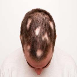 how can alopecia areata betreated