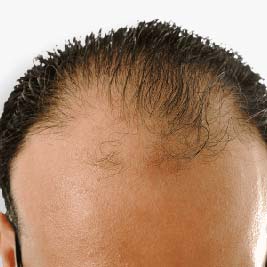 symptoms of androgenetic alopecia