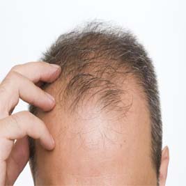 hairloss-what-does-androgenetic-alopecia-look-like