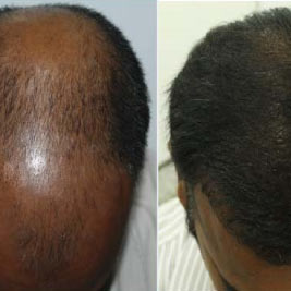 Hair Transplant Clinic in Kochi  Hair Loss Treatment Kochi  Cutis