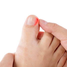 Ingrown toenail causes