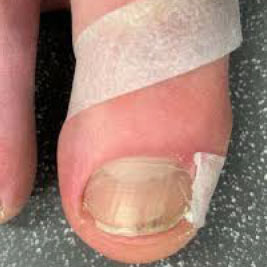 methods to treat ingrown toe nail