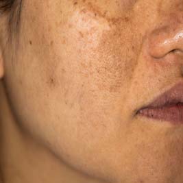 Pigmented lesions and birthmarks