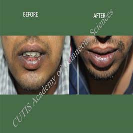 lip surgery suction blister graft