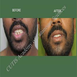 lip surgery vitiligo surgery over lips mucosa