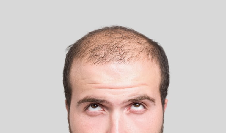 Male Hair Loss Treatment | Hair Loss Treatment for Men in Bangalore