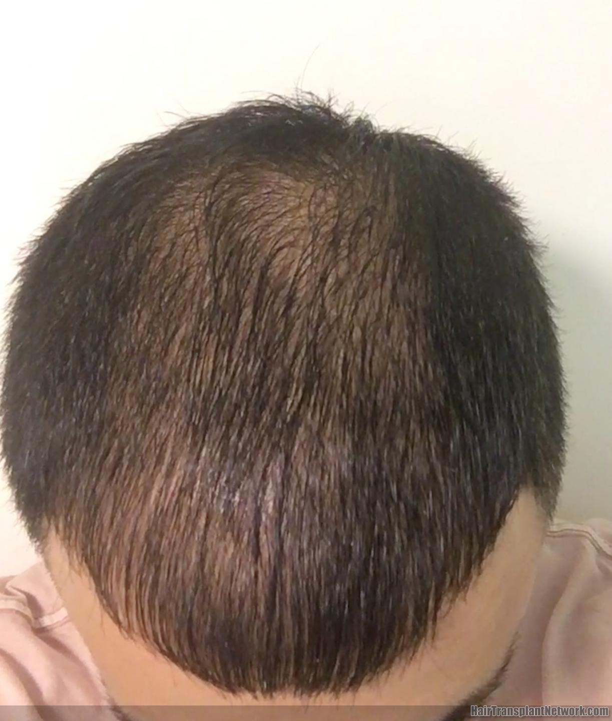 Progressive diffuse scalp hair loss in a woman  Clinical Advisor