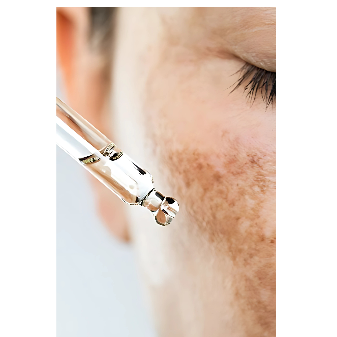 Hyperpigmentation that can be treated by Cosmelan Peel