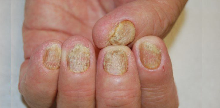 PDF) Twenty-Nail-Dystrophy / Trachyonychia: a case report in a five year  old girl seen at the Paediatric Out-patient Department of a Tertiary  Hospital in Lafia North-Central Nigeria