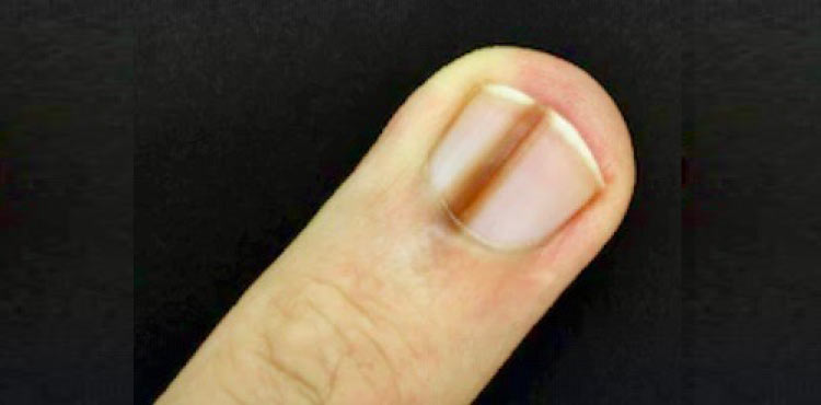 Green Nail Syndrome - American Osteopathic College of Dermatology (AOCD)