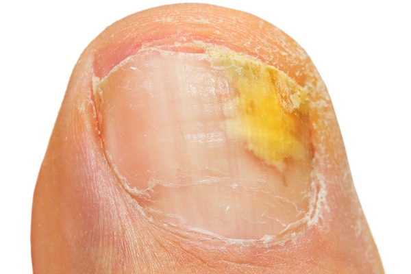 My Toenail Came Off...Now What? | Cone Health