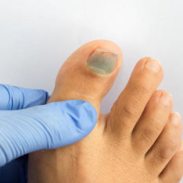 Help for Fungal Toenails Ingrown Nails Warts Corns Calluses Athletes  Foot  Main Street Foot and Ankle LLC