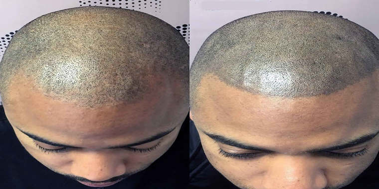 How to Prepare for Scalp Micropigmentation and the Cost