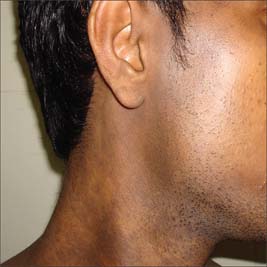 pigmentation-diseases-associated-with-pigmentation