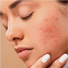etiology of acne