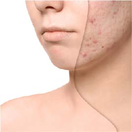 treatment options for acne scars