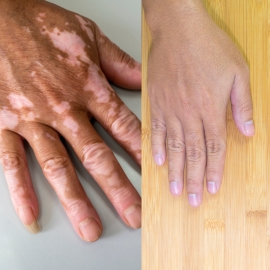 vitiligo-surgery-fue-ht