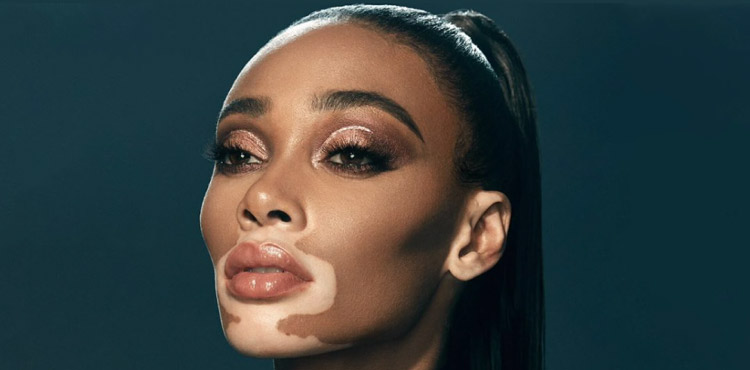 Vitiligo Treatment in Bangalore