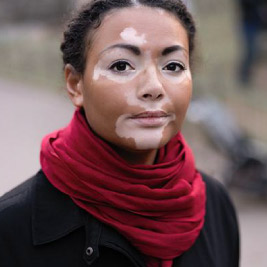 what-are-the-symptoms-of-vitiligo