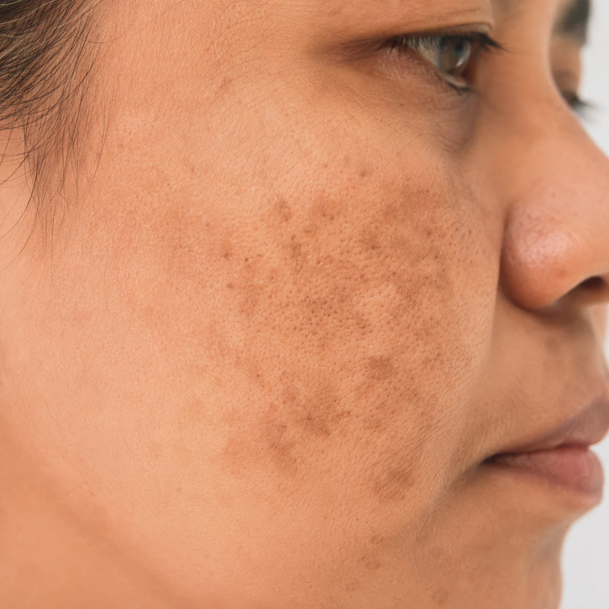 pigmentation